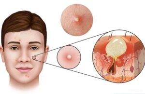 Mụn Viêm Càng Nặn Càng Viêm? Và Đây Là Cách Chăm Sóc Mụn Viêm Tại Nhà