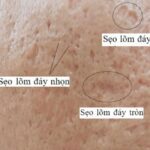 Sẹo Đáy Nhọn Là Sẹo Gì? Vì Sao Lại Là Loại Sẹo Sau Mụn Khó Điều Trị Nhất 6 Sẹo Đáy Nhọn Là Sẹo Gì? Vì Sao Lại Là Loại Sẹo Sau Mụn Khó Điều Trị Nhất