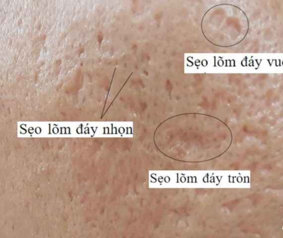 Sẹo Đáy Nhọn Là Sẹo Gì? Vì Sao Lại Là Loại Sẹo Sau Mụn Khó Điều Trị Nhất