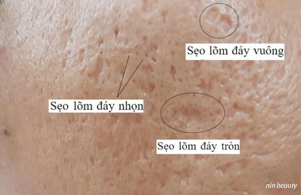 Sẹo Đáy Nhọn Là Sẹo Gì? Vì Sao Lại Là Loại Sẹo Sau Mụn Khó Điều Trị Nhất