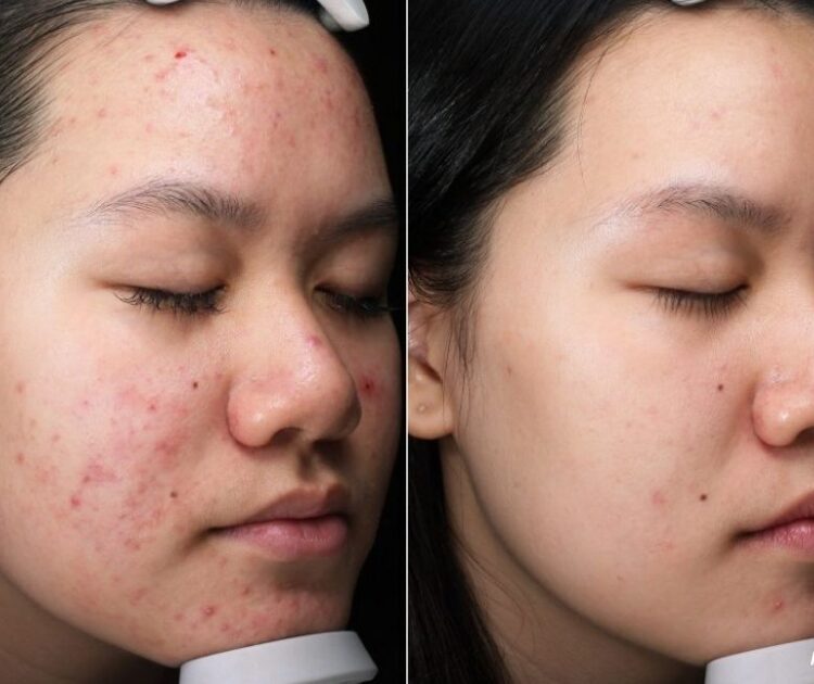 Nên Trị Thâm Mụn Bằng Các Hoạt Chất Nào Để Đạt Được Hiệu Quả Nhanh Nhất