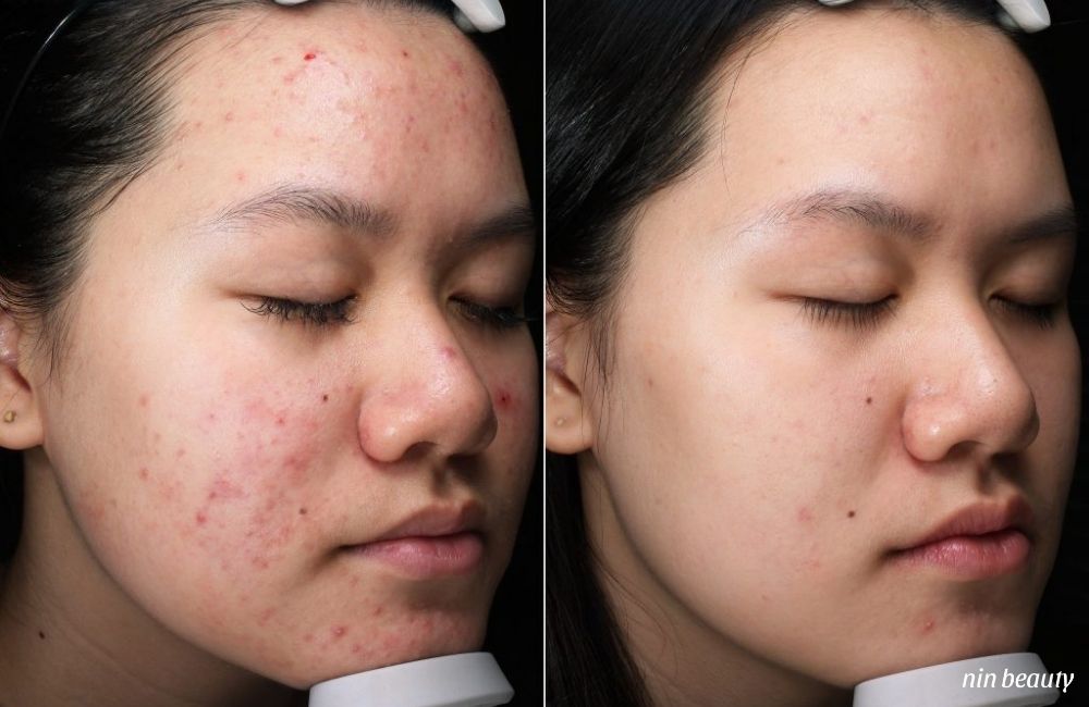 Nên Trị Thâm Mụn Bằng Các Hoạt Chất Nào Để Đạt Được Hiệu Quả Nhanh Nhất