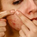 Mụn Viêm Càng Nặn Càng Viêm? Và Đây Là Cách Chăm Sóc Mụn Viêm Tại Nhà