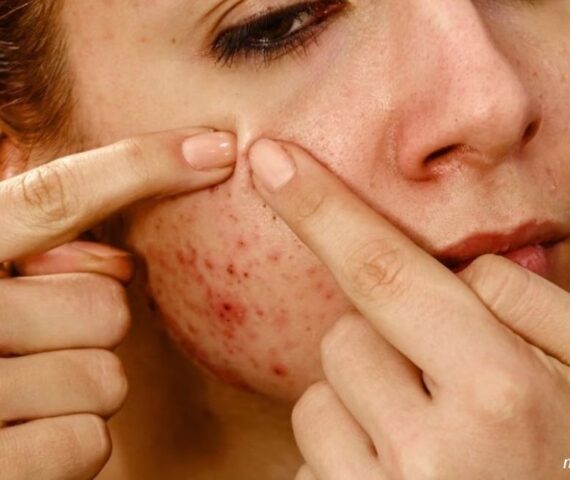 Mụn Viêm Càng Nặn Càng Viêm? Và Đây Là Cách Chăm Sóc Mụn Viêm Tại Nhà