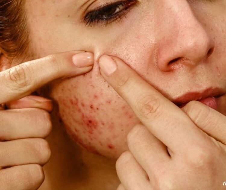 Mụn Viêm Càng Nặn Càng Viêm? Và Đây Là Cách Chăm Sóc Mụn Viêm Tại Nhà