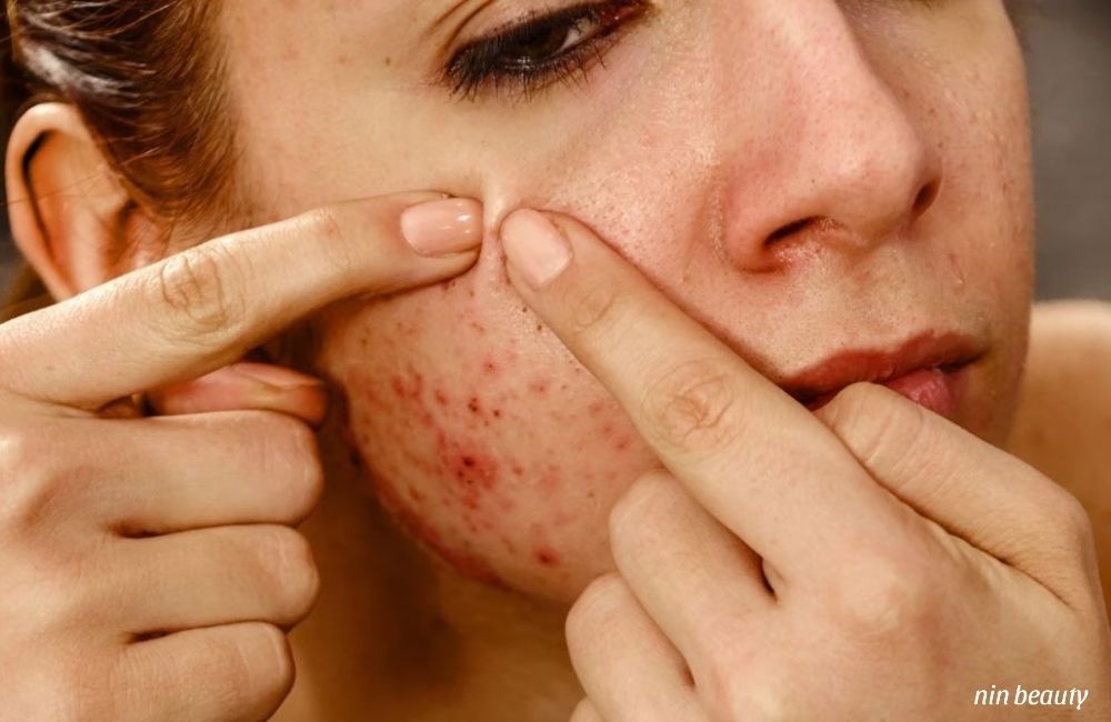 Mụn Viêm Càng Nặn Càng Viêm? Và Đây Là Cách Chăm Sóc Mụn Viêm Tại Nhà