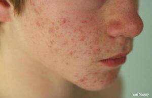Nên Trị Thâm Mụn Bằng Các Hoạt Chất Nào Để Đạt Được Hiệu Quả Nhanh Nhất