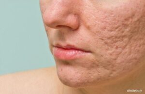 Sẹo Đáy Nhọn Là Sẹo Gì? Vì Sao Lại Là Loại Sẹo Sau Mụn Khó Điều Trị Nhất