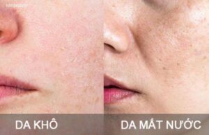 Các Triệu Chứng Cho Thấy Da Đang Mất Nước Và Cách Khắc Phục