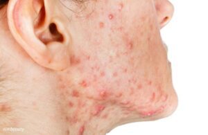Mụn Viêm Càng Nặn Càng Viêm? Và Đây Là Cách Chăm Sóc Mụn Viêm Tại Nhà