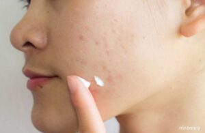 Nên Trị Thâm Mụn Bằng Các Hoạt Chất Nào Để Đạt Được Hiệu Quả Nhanh Nhất