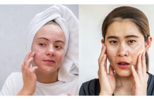 Khi Nào Nên Và Không Nên Dùng Kẽm Cho Da Mụn?