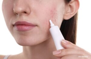 Sẹo Đáy Nhọn Là Sẹo Gì? Vì Sao Lại Là Loại Sẹo Sau Mụn Khó Điều Trị Nhất