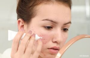 Nên Trị Thâm Mụn Bằng Các Hoạt Chất Nào Để Đạt Được Hiệu Quả Nhanh Nhất