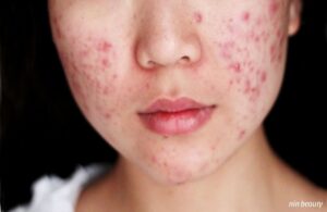 Khi Nào Nên Và Không Nên Dùng Kẽm Cho Da Mụn?