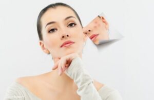 Sẹo Đáy Nhọn Là Sẹo Gì? Vì Sao Lại Là Loại Sẹo Sau Mụn Khó Điều Trị Nhất