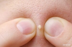 Dùng BHA Đẩy Mụn Cho Người Mới Bắt Đầu Cực Hiệu Quả