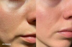 Phương Pháp Laser Hoạt Động Theo Cơ Chế Nào Trên Làn Da?