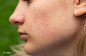 Dùng BHA Đẩy Mụn Cho Người Mới Bắt Đầu Cực Hiệu Quả
