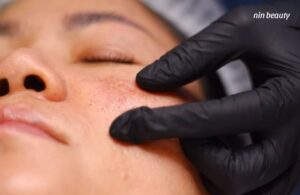 Phương Pháp Laser Hoạt Động Theo Cơ Chế Nào Trên Làn Da?