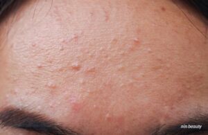 Mụn Nấm Men Da Mặt Là Gì? Cách Để Nhận Biết So Với Các Loại Mụn Khác 2 Mụn Nấm Men Da Mặt Là Gì? Cách Để Nhận Biết So Với Các Loại Mụn Khác