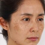 Nám Trên Nền Da Dầu Có Khó Điều Trị Hơn Là Da Thường? 5 Nám Trên Nền Da Dầu Có Khó Điều Trị Hơn Là Da Thường?