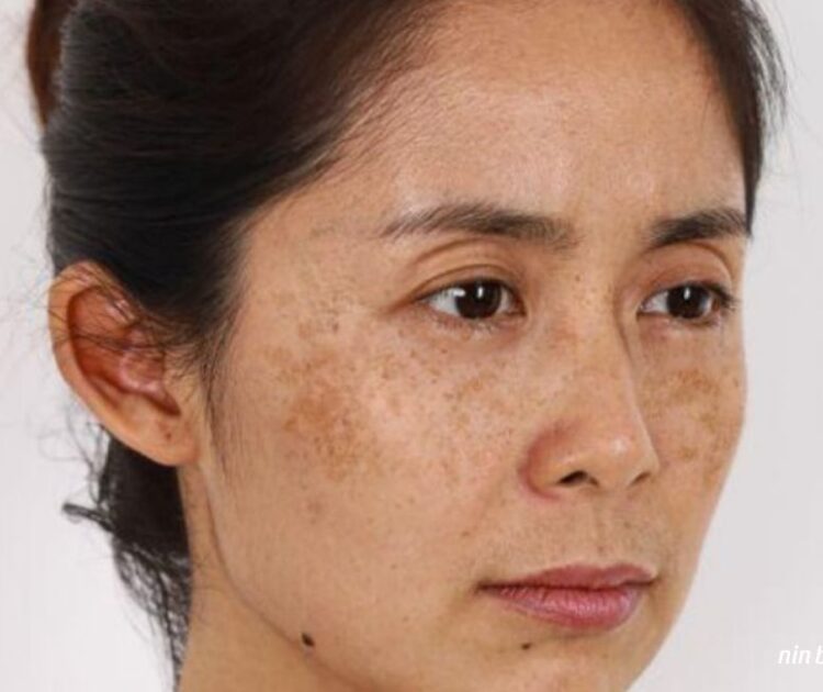 Nám Trên Nền Da Dầu Có Khó Điều Trị Hơn Là Da Thường?