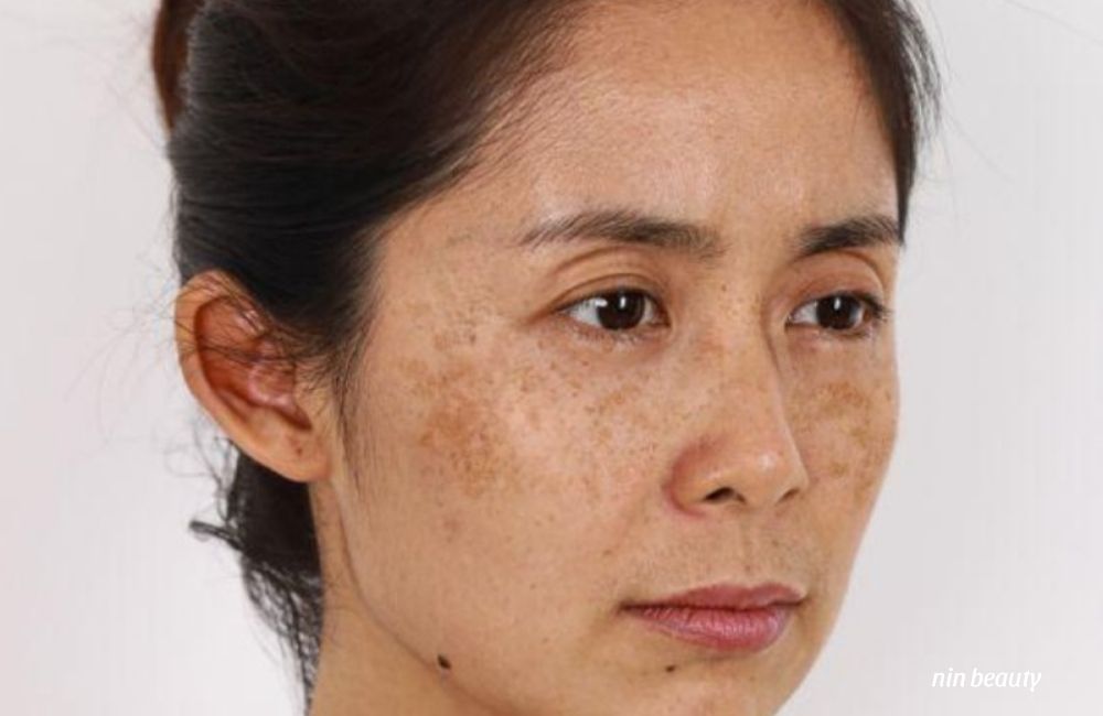 Nám Trên Nền Da Dầu Có Khó Điều Trị Hơn Là Da Thường?