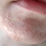 Mụn Nấm Men Da Mặt Là Gì? Cách Để Nhận Biết So Với Các Loại Mụn Khác