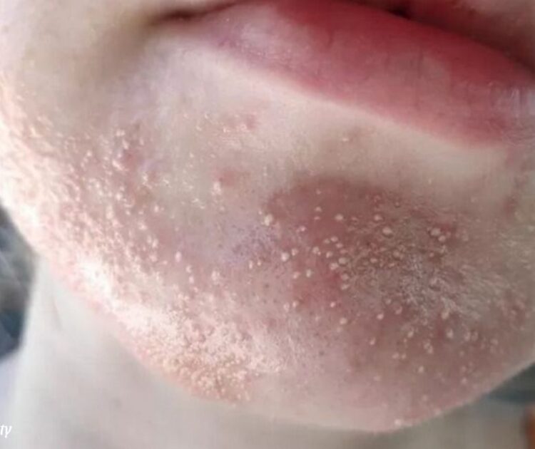Mụn Nấm Men Da Mặt Là Gì? Cách Để Nhận Biết So Với Các Loại Mụn Khác