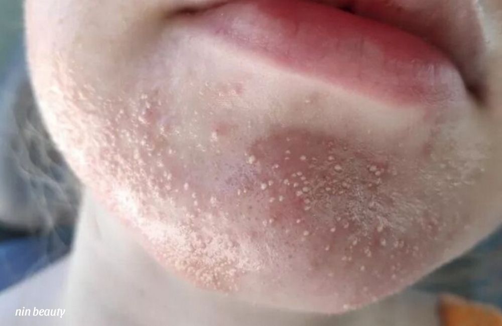 Mụn Nấm Men Da Mặt Là Gì? Cách Để Nhận Biết So Với Các Loại Mụn Khác 1 Mụn Nấm Men Da Mặt Là Gì? Cách Để Nhận Biết So Với Các Loại Mụn Khác