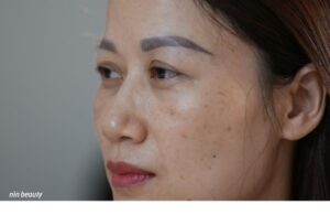 Nám Trên Nền Da Dầu Có Khó Điều Trị Hơn Là Da Thường?