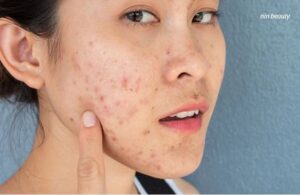 Nám Trên Nền Da Dầu Có Khó Điều Trị Hơn Là Da Thường?