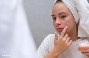 Mụn Nấm Men Da Mặt Là Gì? Cách Để Nhận Biết So Với Các Loại Mụn Khác 3 Mụn Nấm Men Da Mặt Là Gì? Cách Để Nhận Biết So Với Các Loại Mụn Khác