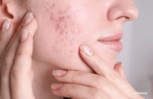 Nám Trên Nền Da Dầu Có Khó Điều Trị Hơn Là Da Thường?